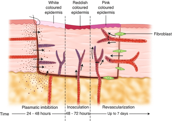 ABSITEQofWeek's tweet photo. #absitequestionoftheweek In the first 24 hours, plasmatic imbibition keeps skin grafts alive. This process, which traces its origins from plant biology, is when normal skin surrounding the graft transfers nutrients via plasma which forms a layer between the two. https://t.co/GUuZDl0AVX