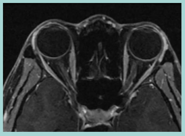 20_20SIM's tweet photo. A 30 yo F pt c/o sudden #vision loss and pain.

Orbital imaging below ⬇️

What’s the most likely #diagnosis?

👉 🧠/👁 case 3⃣: https://t.co/nbv7pBytKO

#NeuroTwitter #ophthalmology #MedEd https://t.co/aJJzXByNlL