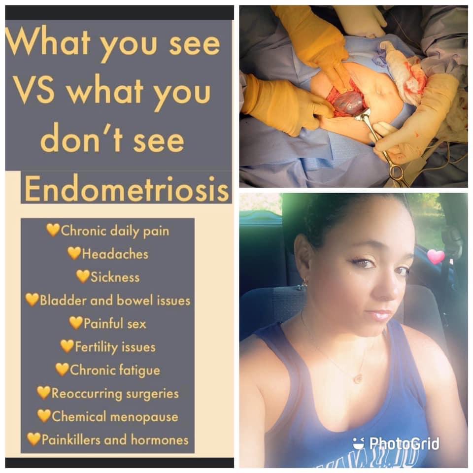 #endometriosis