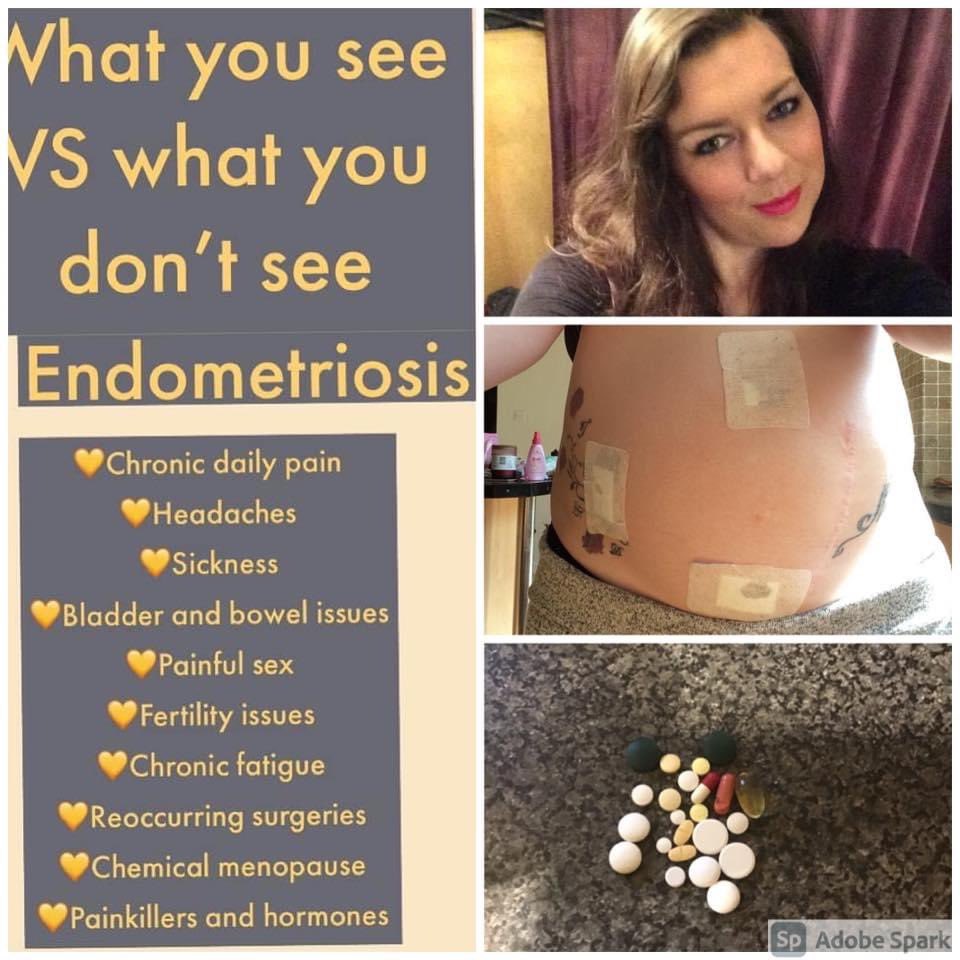 #endometriosis