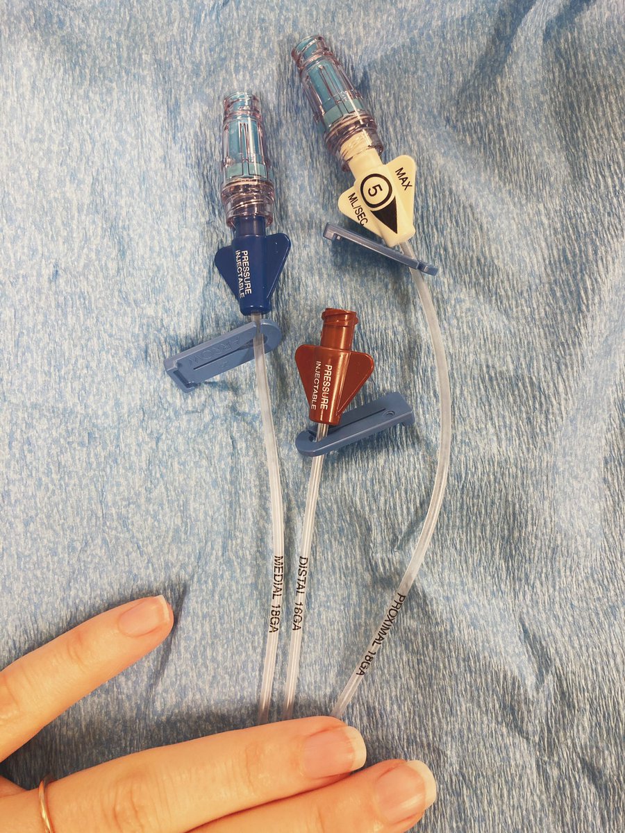 It has three lumens—two 18 gauge side ports and a 16 gauge distal port (the brown port, where your wire will come out). I have developed the habit of flushing the line before I start and making sure I know which is the distal port. Can be NOT the brown port in some lines.