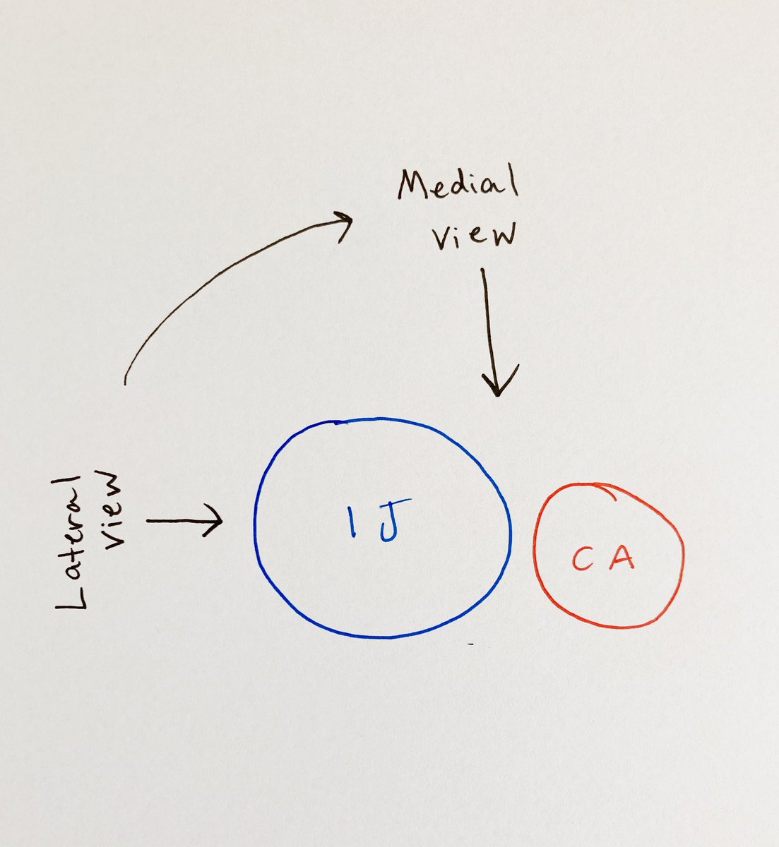 Nobody likes it when the carotid is directly behind your IJ (first picture). If this happens, slide your probe more medially on the neck (second picture). This can help separate them out.