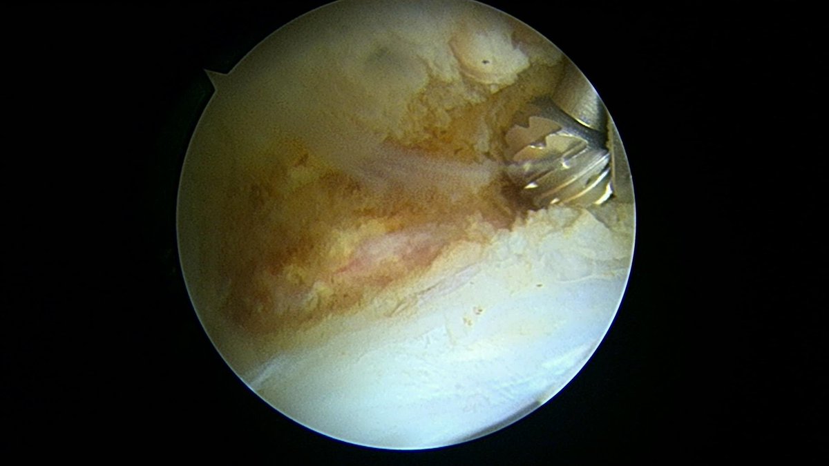 CzarneckiMD's tweet photo. Classic hip labral tear with combined acetabular pincer and femoral head cam impingement. After removing the pincer with a burr, we stabilized the labrum, this time using ribbon all-suture anchors #hiparthroscopy #hiplabralrepair https://t.co/W8L9U6Q9RP