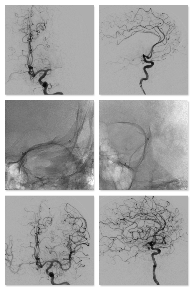 SHAHID NIMJEE (@shahidnimjee) on Twitter photo TracStarLDP (Large Distal Platform) in cavernous ICA with Zoom 055 first in superior M2, then inferior M2, then out. <a href="/imperative_care/">Imperative_Care</a> <a href="/NeurosurgeryOSU/">Ohio State Neurosurgery Residency</a> #zoominzoomout #neurOSUurgery #TracStarLDP #Zoom55 #imperativecare TracStarLDP (Large Distal Platform) in cavernous ICA with Zoom 055 first in superior M2, then inferior M2, then out. <a href="/imperative_care/">Imperative_Care</a> <a href="/NeurosurgeryOSU/">Ohio State Neurosurgery Residency</a> #zoominzoomout #neurOSUurgery #TracStarLDP #Zoom55 #imperativecare