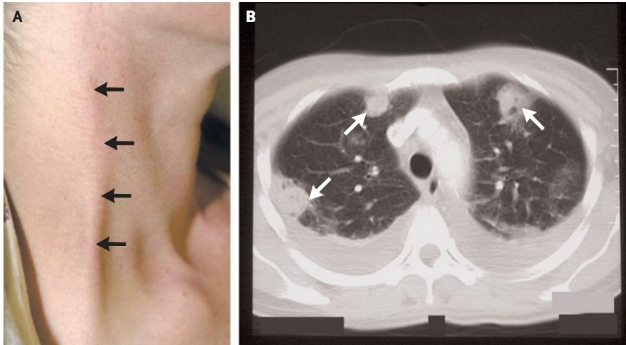 #Complications: Septic emboli from the Internal jugular vein commonly cause severe pulmonary emboli, making  #respiratory symptoms & complications key in these patients. Septic emboli can also travel & affect other organs. 5/8 https://www.nejm.org/doi/pdf/10.1056/ENEJMicm030003