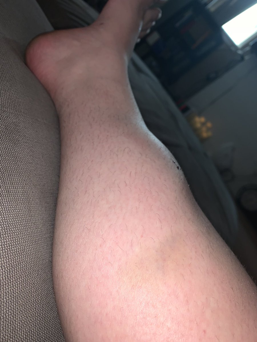 tigerweeb's tweet photo. so uh look at that bruise. (excuse my hairy af legs) https://t.co/AuNMUy0gG2