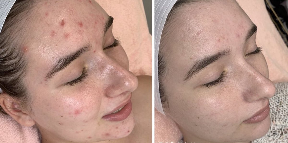 jaymefessler's tweet photo. Feel free 2 shre &amp; support a small local business:) I am a 19 y/o licensed esthi offering $50 advanced facials for the hour🧚🏻‍♀️ my facials include 20 minute massage, Hydrojelly mask, dermaplanning, and more :) Local spas charge $80+! Plz RT and follow @/THELOCALESTHETICIAN on IG✨ https://t.co/TmNvOwMcWX