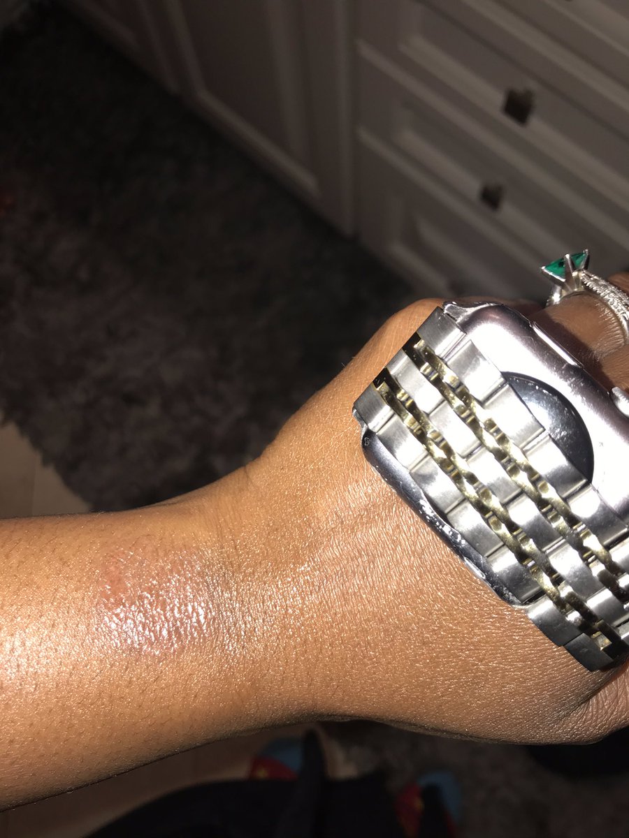 OntheVergeLLC's tweet photo. Does anyone else with an  @Apple watch skin react like this? Can you be allergic to the watch? #allergic#applewatch https://t.co/mpx3eMj8kI
