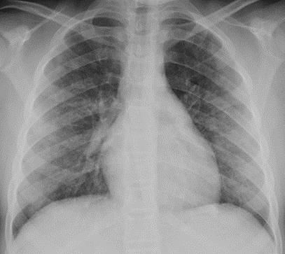 thoracicrad's tweet photo. August 2020 Thoracic Case of the Month:

11 year old girl with dyspnea and hemoptysis… presented by Drs. Angelica Patino &amp; @LucyModahlMD from @UMMSRadiology.

https://t.co/7OxcjFRiQG https://t.co/UpEaPxWyEJ
