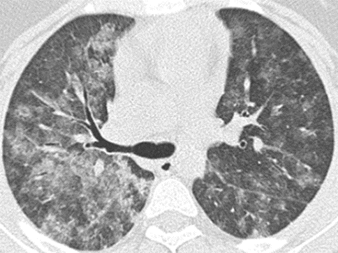 thoracicrad's tweet photo. August 2020 Thoracic Case of the Month:

11 year old girl with dyspnea and hemoptysis… presented by Drs. Angelica Patino &amp; @LucyModahlMD from @UMMSRadiology.

https://t.co/7OxcjFRiQG https://t.co/UpEaPxWyEJ