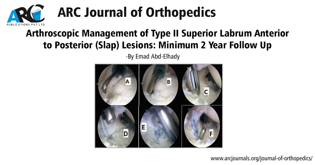 arcjournals's tweet photo. Arthroscopic Management of Type II Superior Labrum Anterior to Posterior (Slap) Lesions: Minimum 2-Year Follow Up -  By  Emad Abd-Elhady 
DOI: https://t.co/cU8n8VOO8Q
ARC Journal of Orthopedics
https://t.co/sQ8Hc2ldZt
#Orthopedics #Management  #Lesions https://t.co/nWE9KNgbYP