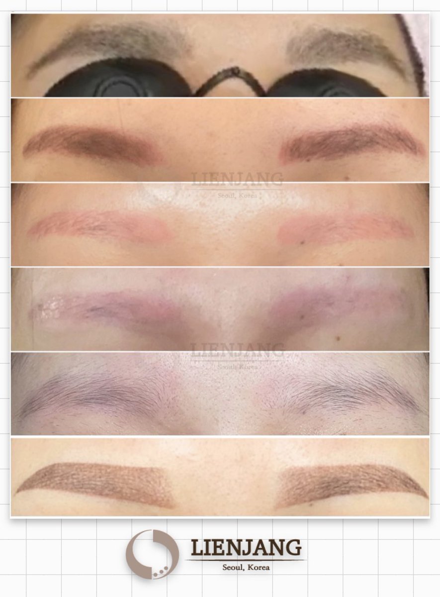 韓国美容 リエンジャン江南店 韓国整形 アートメイクの除去3回後 新たなアートメイクに仕上げましたー 真っ黒な眉毛と形がずっと気になり ３ヶ月かけてアートメイクを除去し 新しい眉毛に生まれ変わりました アートメイク 整形 アイブロウ