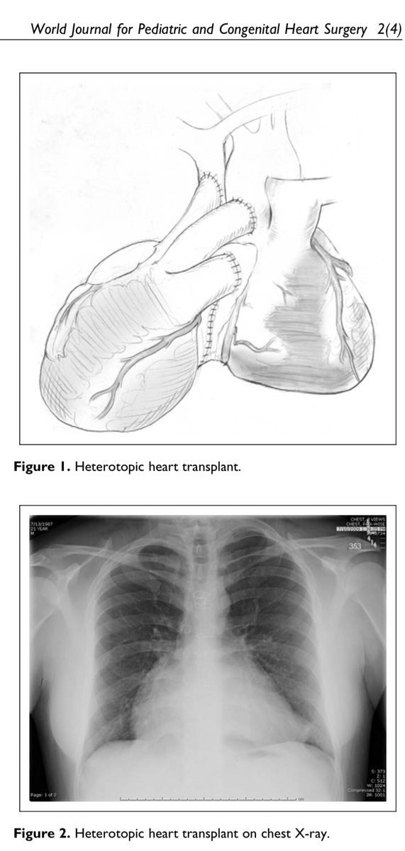 📌Trasplante❤️heterotópico🤓😍

¿Han tenido la oportunidad de verlo?

No es ampliamente utilizado, aún menos en la era de los LVADs 💵🌎, existen situaciones puntuales para este
𝐋𝐕𝐀-𝐛𝐢𝐨𝐥ó𝐠𝐢𝐜𝐨

Datos📚:
•Primero, trabajos experimentales de Demikhov🇷🇺a inicios de lo 60’