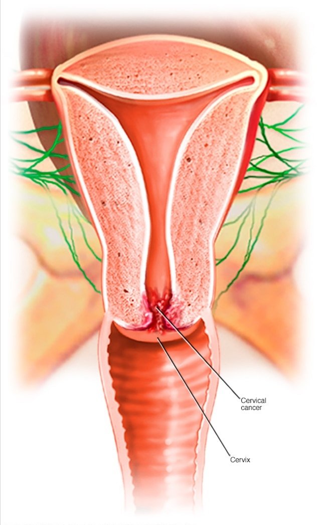 Cervical cancer is a type of cancer that occurs in the cells of the cervix which is the lower part of the uterus (Womb) that connects to the vagina.Various strains of Human Papillomavirus (HPV) which is a sexually transmitted infection, play a role in causing most cerivcal cancer