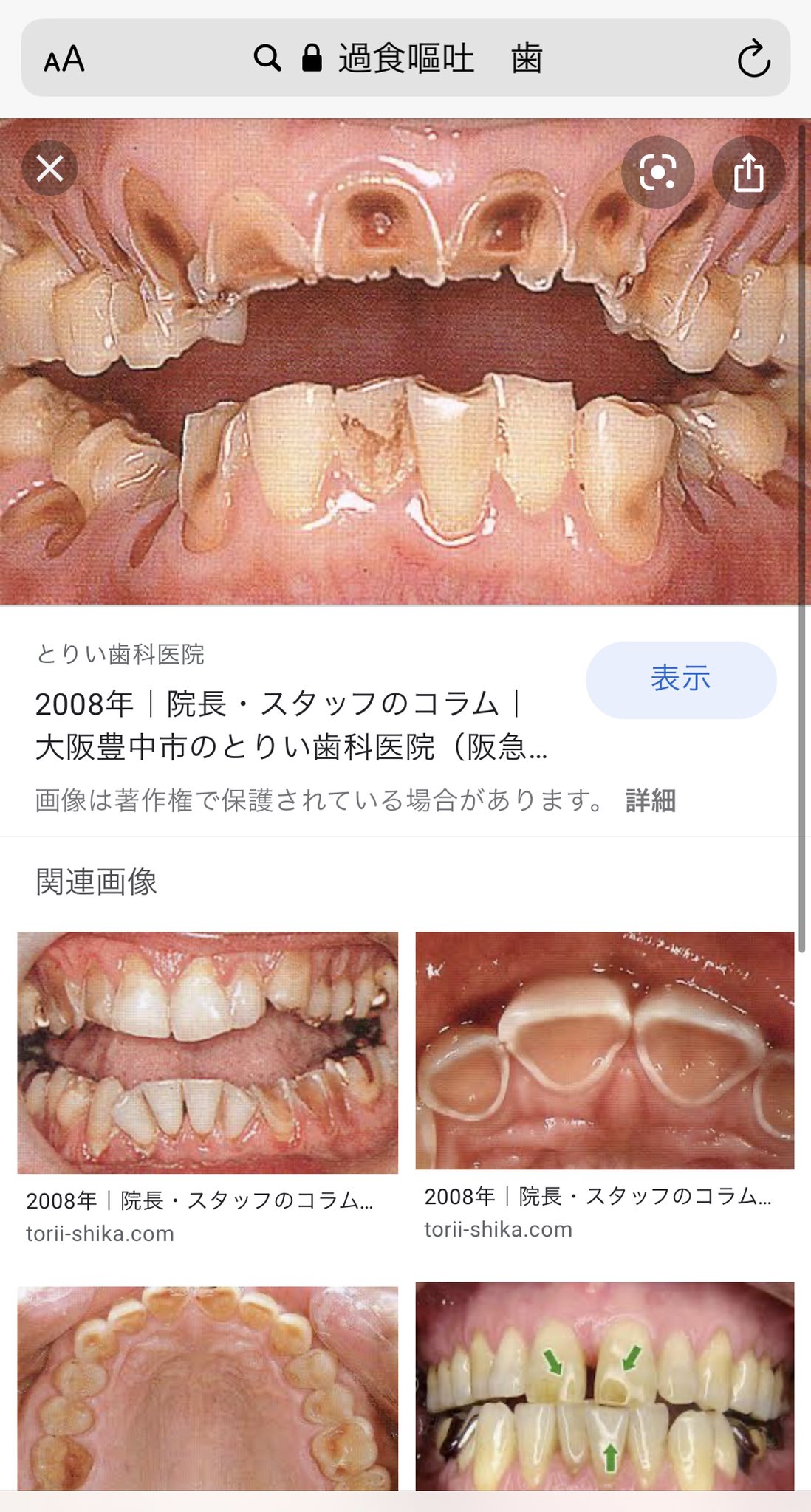 パピコ 過食嘔吐って1度ハマると簡単にはやめられないけど 長引くと胃壁が壊死して死ぬし 歯も死ぬ とりあえず面倒だけどマウスピースつけて吐いた方がいいよ あとダイエットでお酢ドリンクも流行ってたりするけど何年も続けると溶けるみたい 柑橘系の