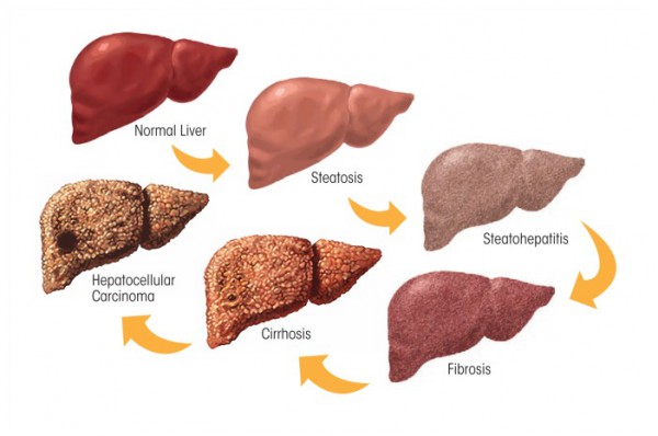 Lambat laun, hati PASIEN akan mengalami sirosis.Gambar di bawah menunjukkan perkembangan patologis liver manusia dari normal menuju sirosis hingga kanker akibat konsumsi alkohol berlebih dalam jangka panjang.Nahloh, sudah jadi PASIEN aja nih status peminumnya.