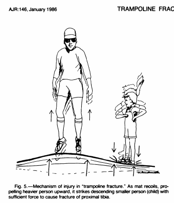  #WeekendReview case 3: A trampoline fracture is an incomplete transverse fracture of the proximal tibial metaphysis. It occurs during tandem jumping where a heavier jumper causes the mat to recoil as a smaller person lands. Check out the classic  @AJR_Radiology article from 1985
