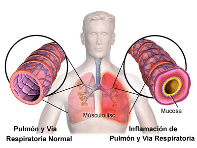 vicatallah's tweet image. La inflamación de las vías respiratorias se comporta como barrera para el paso de oxigeno desde el alvéolo al torrente sanguíneo #VEA