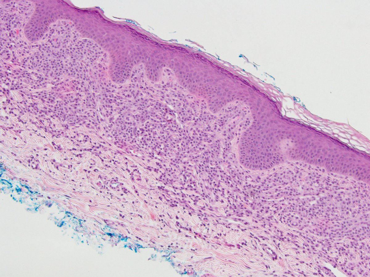 Interesting case (from our archives!) to start the week: A woman in her 60s with asthma and chronic rhinitis presents with a new morbilliform rash on trunk & extremities. Skin biopsy shown below; initial thoughts/next steps to consider? More information to follow...  #PathTwitter