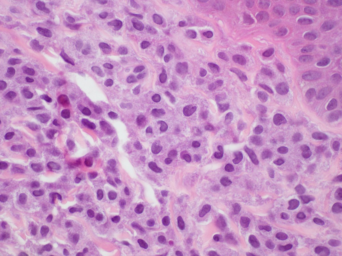 Interesting case (from our archives!) to start the week: A woman in her 60s with asthma and chronic rhinitis presents with a new morbilliform rash on trunk & extremities. Skin biopsy shown below; initial thoughts/next steps to consider? More information to follow...  #PathTwitter