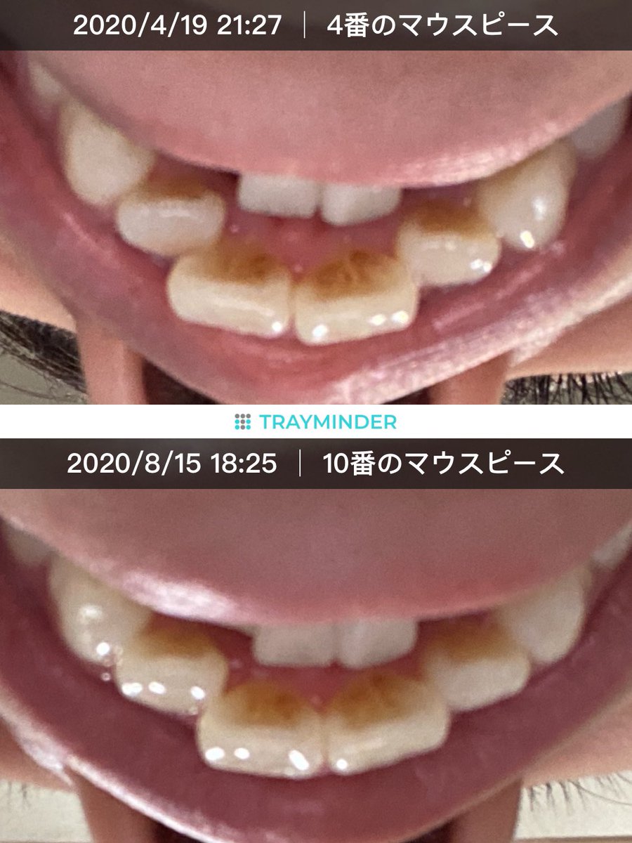 mmm48696917's tweet photo. 上の歯の経過 https://t.co/d0RX7ViiUu