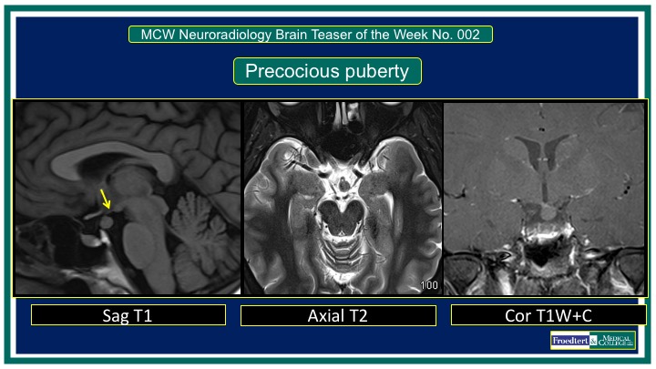 PublishedXPrime's tweet photo. #MCWNeuroradBTW 002: Precocious Puberty

Submit answers at:
https://t.co/nkbfmTL0qc to win exciting prizes!

Quiz opens Mon &amp; closes Wed5pm CST. Answers Fri/Sat

PLEASE DO NOT POST ANSWERS, GIFs, HINTS etc IN COMMENTS. Check out more quiz rules.

@MCWNeurorad https://t.co/34RDffHB49