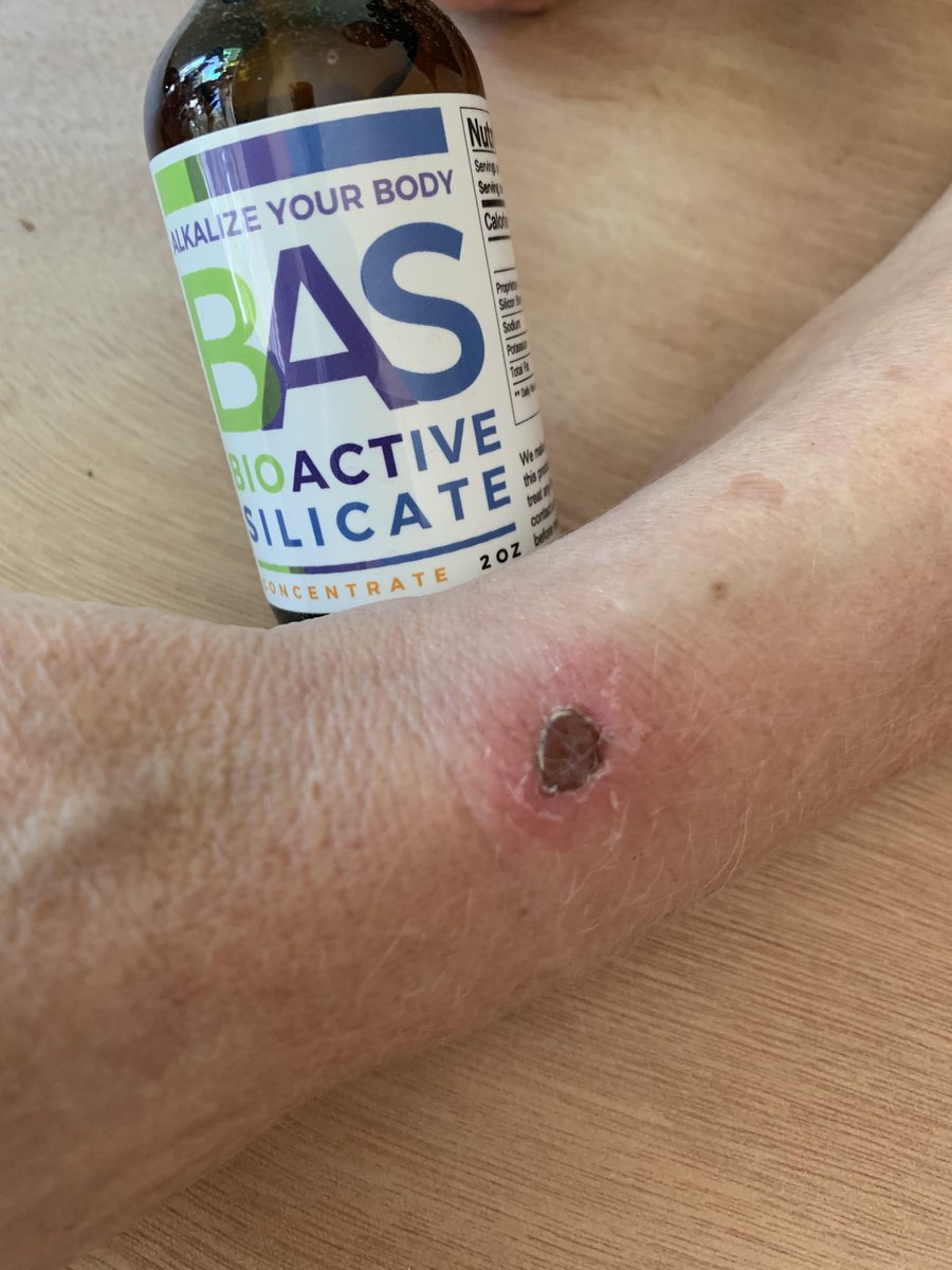 BasSilicate's tweet image. Our Customer bitten by spider (supposedly by Brown Recluse) and started using #BioActiveSilicate (#BAS) early on.

You can see the recovery in pictures Within A Month Only!!!!!

#bioactivesilicate #Immunity #HealthMantras #healthylifestyle #nutrition