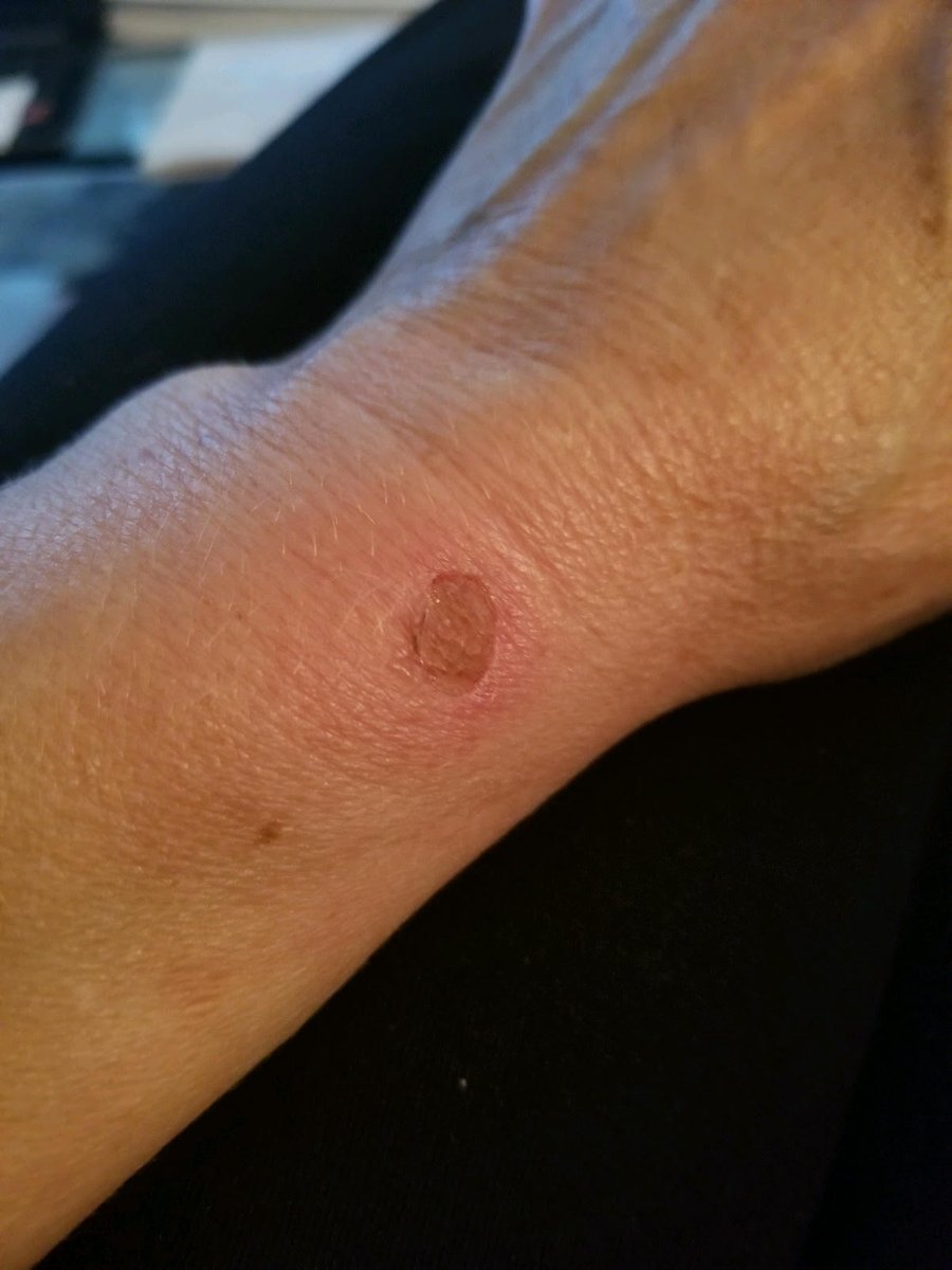 BasSilicate's tweet image. Our Customer bitten by spider (supposedly by Brown Recluse) and started using #BioActiveSilicate (#BAS) early on.

You can see the recovery in pictures Within A Month Only!!!!!

#bioactivesilicate #Immunity #HealthMantras #healthylifestyle #nutrition