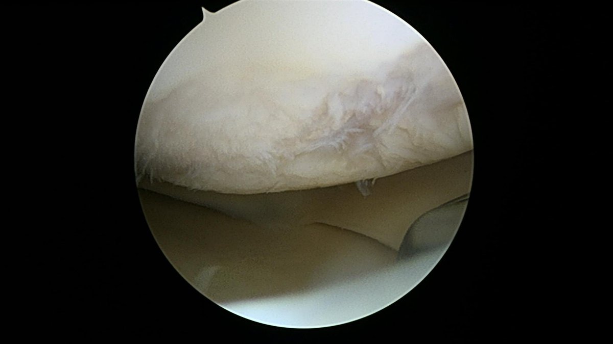 CzarneckiMD's tweet photo. After debriding this MFC defect, we took a biopsy of the patient’s own normal cartilage. @VericelCorp can perform cell culture for MACI matrix-induced autologous chondrocyte implantation in about a month. The donor site rarely causes any symptoms #chondraldefect https://t.co/ylpCdGtHzA