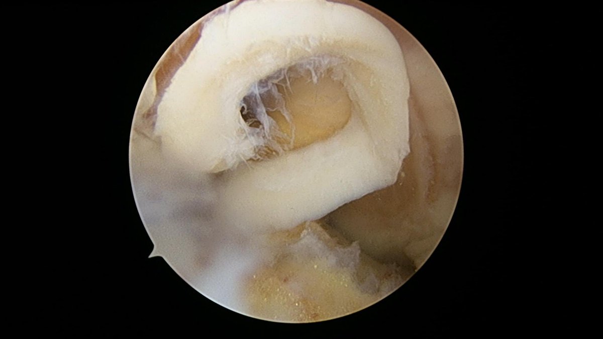 CzarneckiMD's tweet photo. After debriding this MFC defect, we took a biopsy of the patient’s own normal cartilage. @VericelCorp can perform cell culture for MACI matrix-induced autologous chondrocyte implantation in about a month. The donor site rarely causes any symptoms #chondraldefect https://t.co/ylpCdGtHzA