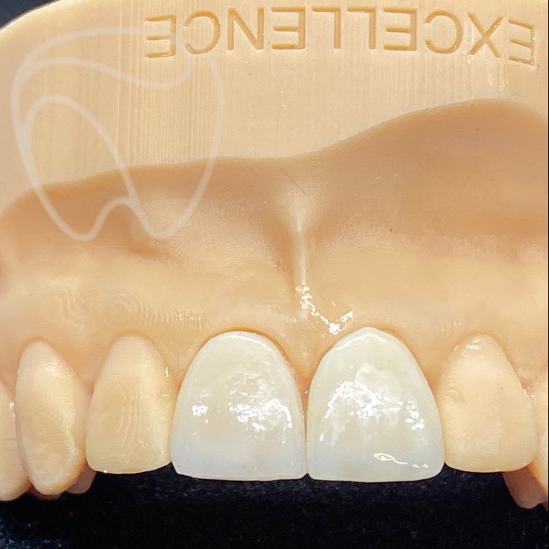 LabExcellence's tweet photo. E.max veneers created at Dental Excellence #emax #dental #dentallab #dentist #dentistry #3dprinting https://t.co/HzfQRTWqYC