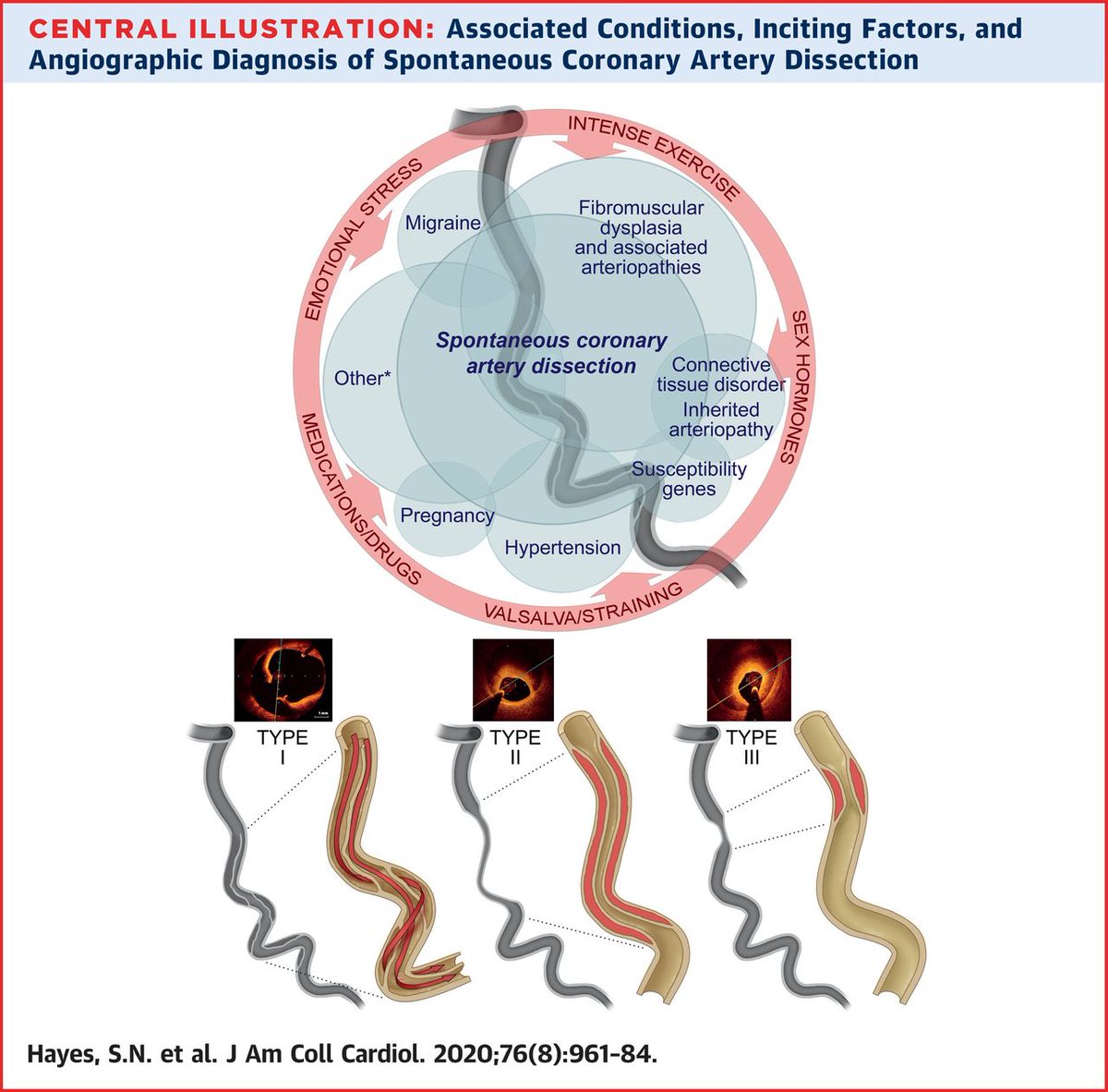Sharonne Hayes MD (@sharonnehayes) on Twitter photo Spontaneous Coronary Artery Dissection
<a href="/JACCJournals/">JACC Journals</a> State-of-the-Art Review online today (link in thread).Check out the many images of "diagnostic dilemas" & management challenges Spontaneous Coronary Artery Dissection
<a href="/JACCJournals/">JACC Journals</a> State-of-the-Art Review online today (link in thread).Check out the many images of "diagnostic dilemas" & management challenges