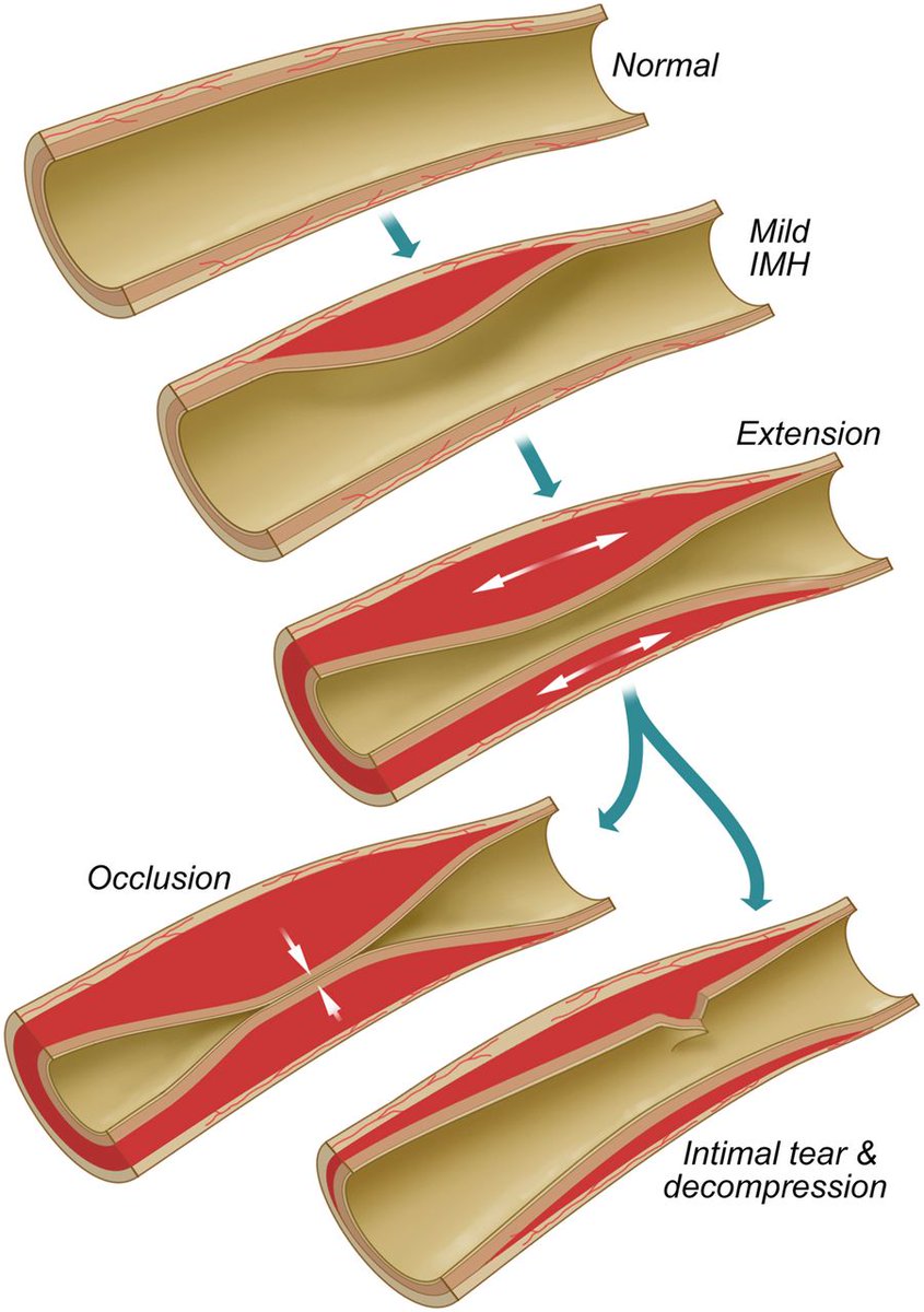 SharonneHayes's tweet photo. Spontaneous Coronary Artery Dissection
@JACCJournals   State-of-the-Art Review online today (link in thread).Check out the many images of "diagnostic dilemas" &amp; management challenges https://t.co/ONNtfWCPRR