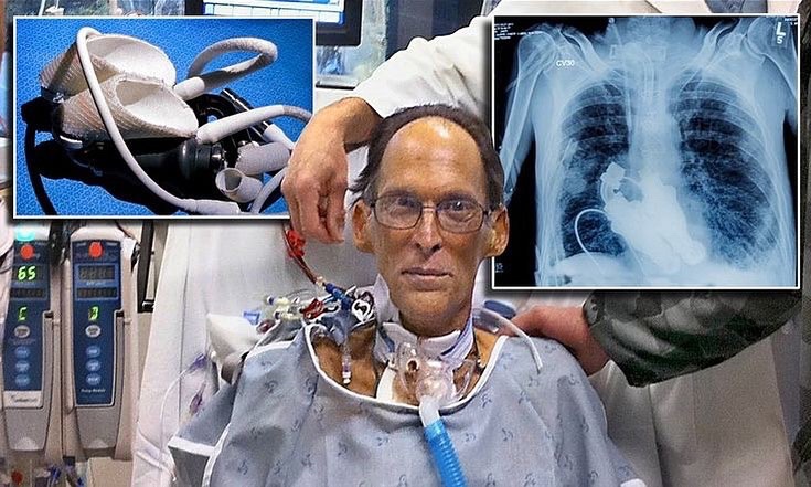 kenradio's tweet photo. Meeting Craig Lewis, 55, is the first heartless human who is literally living without a pulse. The possibility of replacing someone's dying heart with pump to save a person only seems achievable in movies and science fiction https://t.co/Uok6FQvu3i https://t.co/ROCBgjxwcD