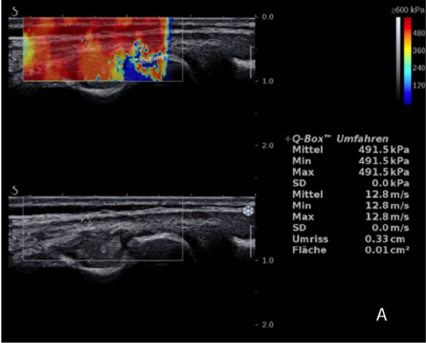 JFEsculier's tweet photo. If you're convinced that IT Band stiffness should be reduced in people with IT Band syndrome, here's a challenging one via #PhysicalTherapyInSport : ⬇️Pain, but⬆️ITB stiffness after treatment 😂🤷‍♂️https://t.co/ueEZfEMJTT https://t.co/QLfkw4TjAe