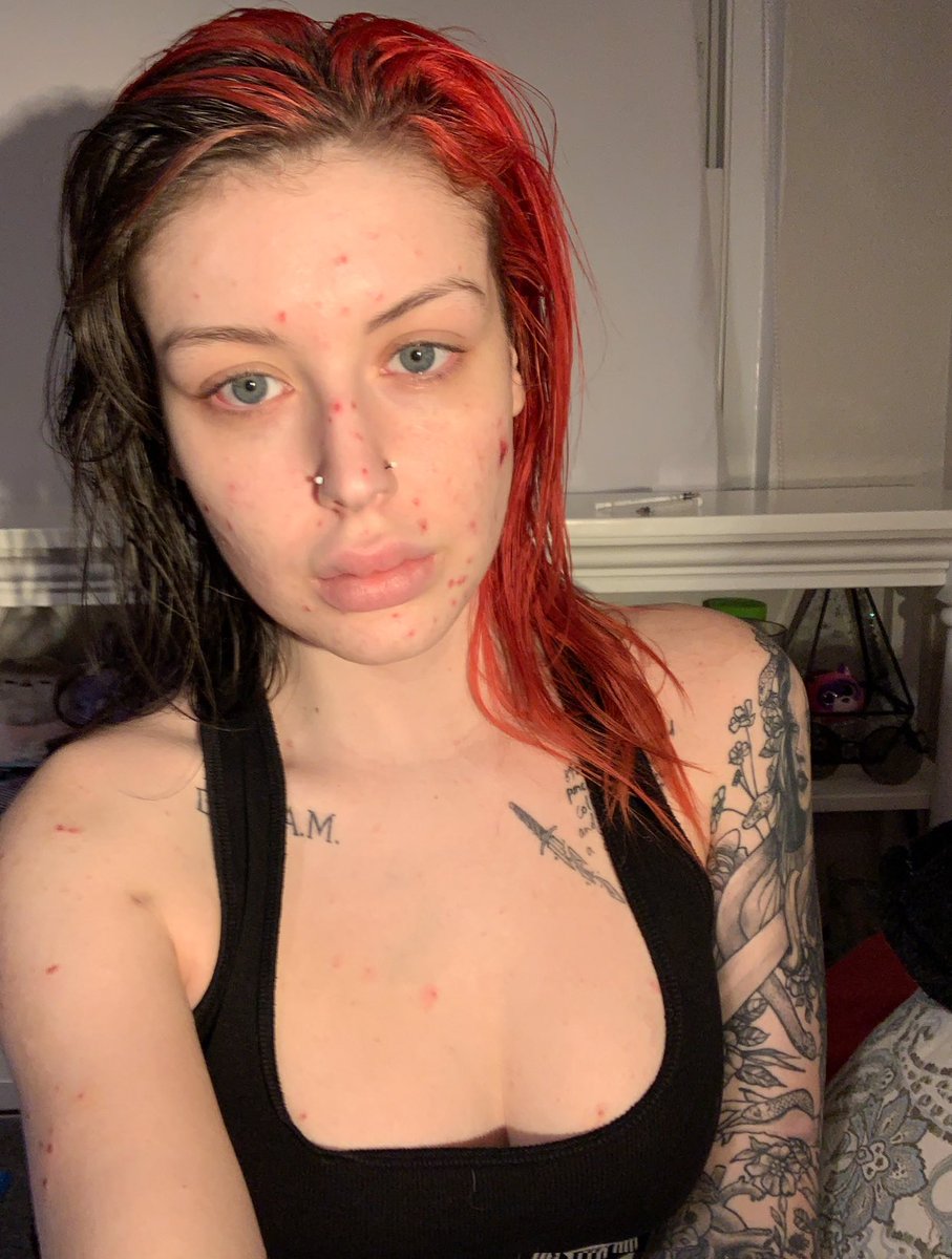heroin and meth face
vs
sober face and body !!!!
if you’re struggling, take that uncomfortable and scary leap and fight to get your souls back. I believe in u all so much https://t.co/V7YNOUswy7