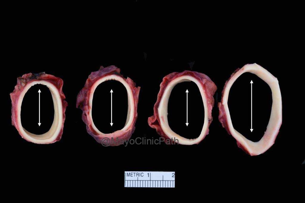 MayoClinicPath's tweet photo. 1/14 The wait is over!!  Here comes the #HEARTThursday answer via #Pathtweetorial w/ @MelanieBoisMD!   Read along below!  Drop a comment below to let us know if you had expected the answer below! #CPpath #APpath #CardiacPath #PathTwitter https://t.co/mvT8MomQg8