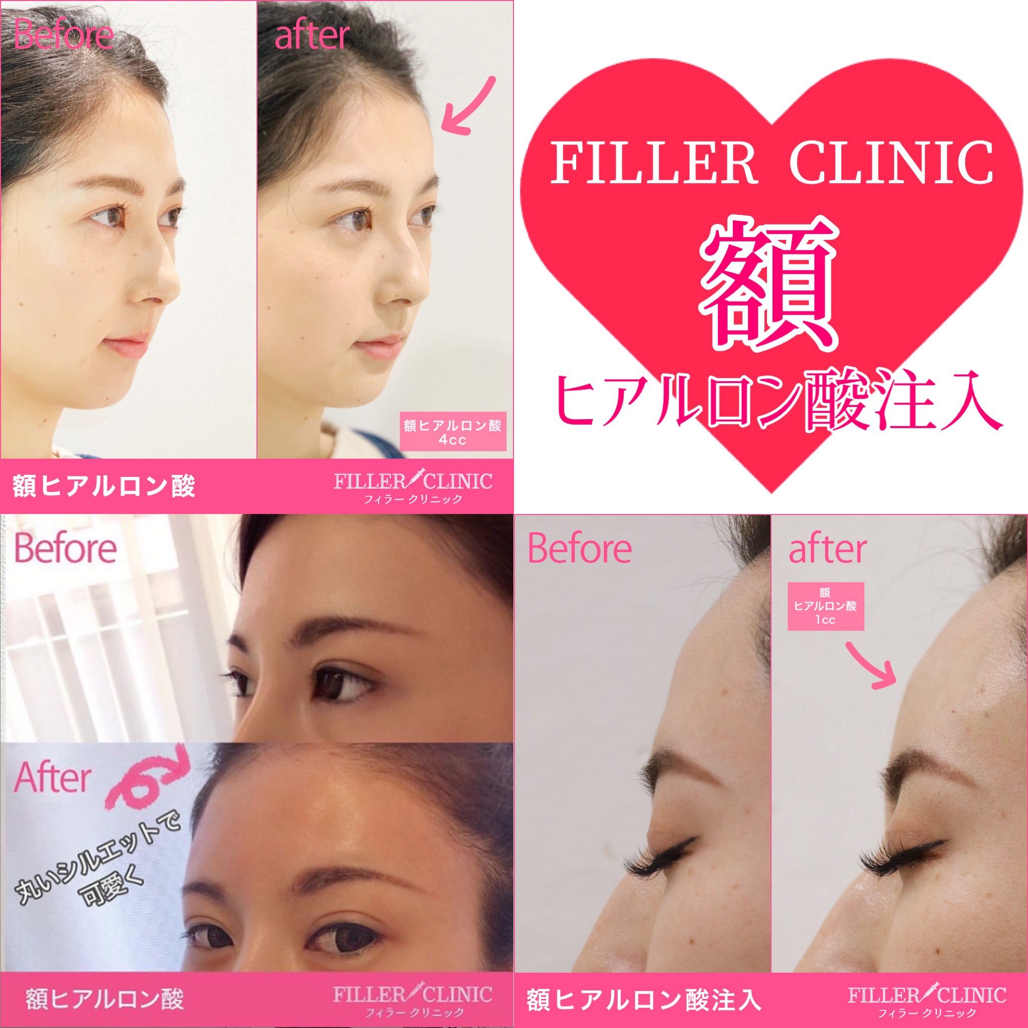 フィラークリニック 公式 Twitter वर モニター企画第3弾 額ヒアルロン酸注入モニター募集 額ヒアルロン酸注入 の部分モニターを募集します 詳しくは画像をチェック モニター募集 額 おでこ ヒアルロン酸