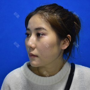 meirong3333's tweet photo. 上:術前
下:術後
施術名:顔の脂肪吸引とナチュラルな鼻の整形
🏥深セン医療美容クリニック

#整形垢さんと繋がりたい #美容垢さんと繋がりたい https://t.co/OMrpIA252f