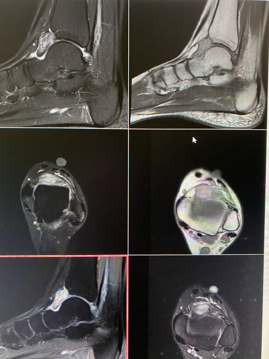 Focal pigmented villo-nodular synovitis (PVNS):A small nodular synovial proliferation is seen indenting the anterior fat of the ankle joint. Exam performed post contrast administration. #msk #mskradiology #anklejoint