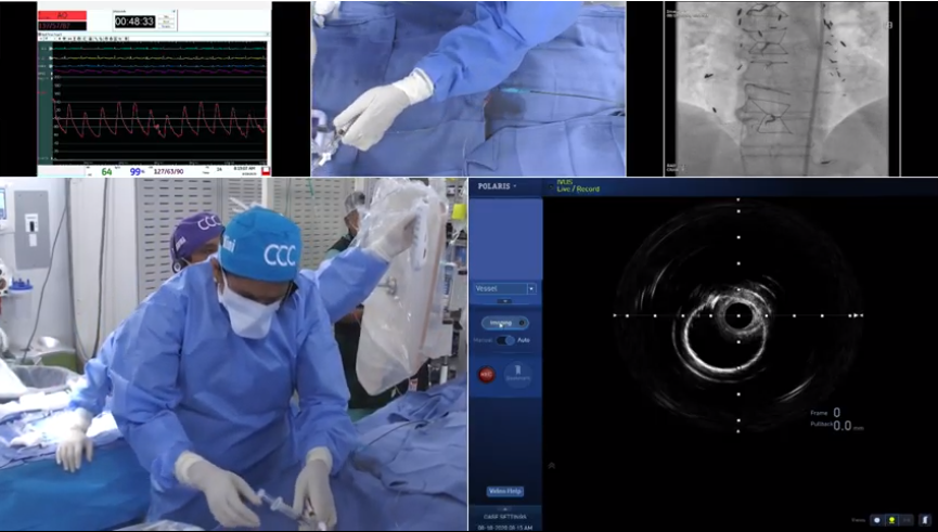 ccclivecases's tweet image. Ask your questions LIVE now at ccclivecases@gmail.com

Live Case: "Stent Ablation with RA of Underexpanded Multilayer DES" 
ccclivecases.org/live-webcast/

#instentrestenosis #oct #rotablator #ccclivecases #mountsinai #interventionalcardiology #cardiology