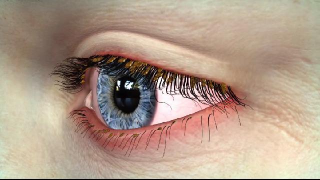sight_nu's tweet image. ow.ly/HBlB102kymn ow.ly/e6tR102kymi Demodox blepharitis treatment shows positive results, says Tarsus - Optometry Times
