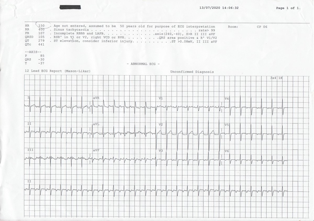 ConnollyED2's tweet photo. Some great ECGs discussed during our inaugural #ECGClub! Looking forward to our next session @RachelGilmore12 @eoconor209 @GiveAoiFox @TiarnanByrne @davecurley13 https://t.co/M5XNRbQ1gJ