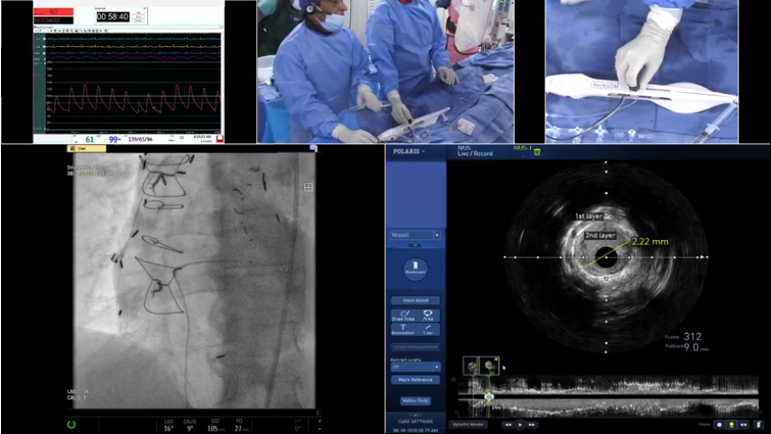 ccclivecases's tweet image. "Stent Ablation with RA of Underexpanded Multilayer DES" 
ccclivecases.org/live-webcast/
SEND your questions LIVE now to ccclivecases@gmail.com

#instentrestenosis #oct #rotablator #ccclivecases #mountsinai #interventionalcardiology #cardiology