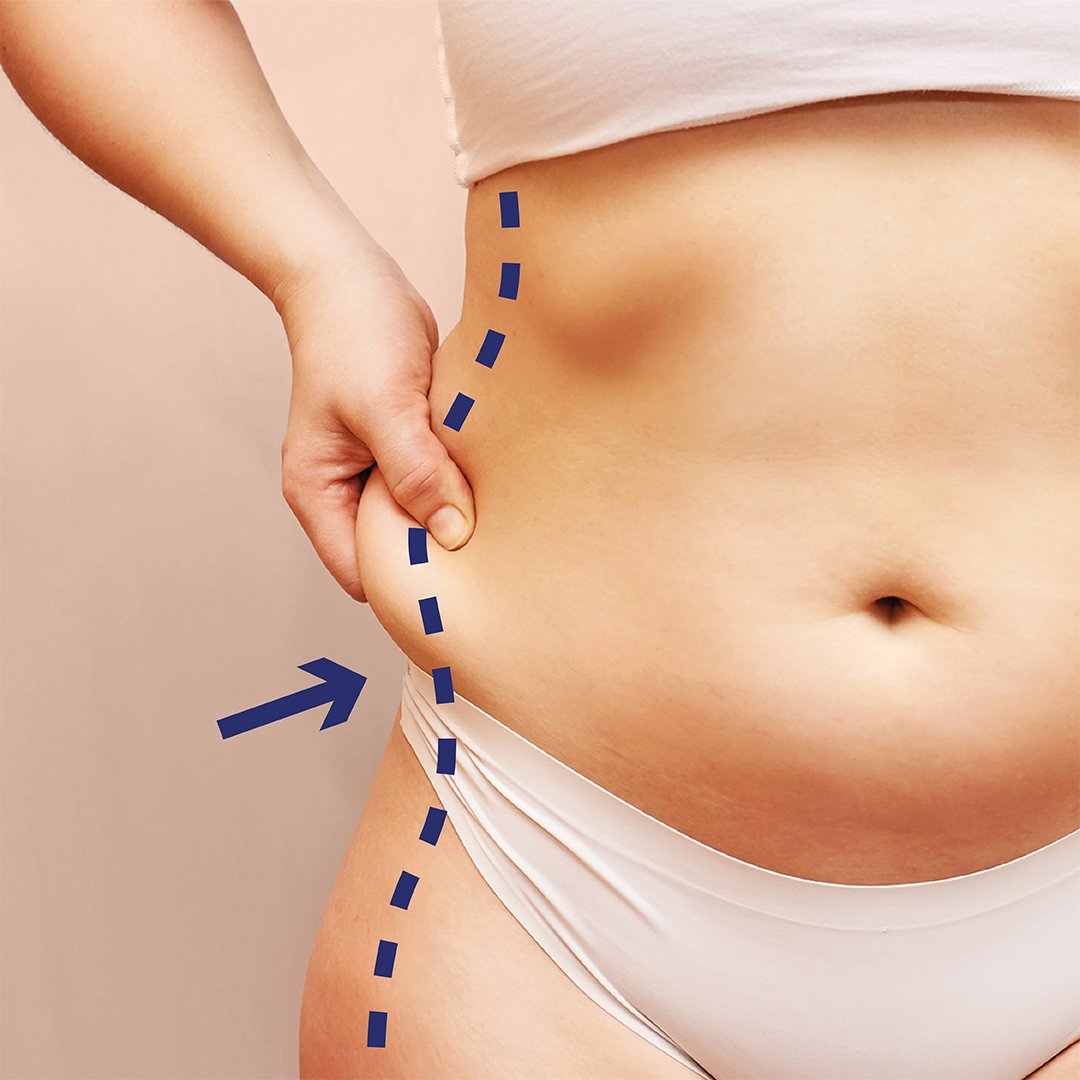 RiverMedical1's tweet photo. Love handles, bingo wings and double chins be gone!🚫 

The phenomenal treatment will decrease your fat cells by 25% with each treatment. 🙌 

Book your consultation with one of our CoolSculpting experts today at 📧 info@rivermedical.ie or by following the link in our bio🔗 https://t.co/QmtfzJBdqR