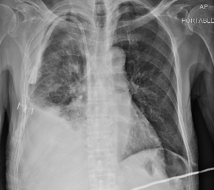Northwestern IM Chiefs (@nuim_chiefs) on Twitter photo Hello #MedTwitter! #MorningReport today w/ @macwalterMD <a href="/ArushiSinghMD/">Arushi Singh</a> and @DxRxEdu! 82M w/ T2DM, ESRD on HD, MGUS, p/w SOB, cough & anorexia. Exam w/ decreased R basilar sounds and this #CXR. Initial #ddx is broad, but what if we told you this was a recurrent R pleural effusion? Hello #MedTwitter! #MorningReport today w/ @macwalterMD <a href="/ArushiSinghMD/">Arushi Singh</a> and @DxRxEdu! 82M w/ T2DM, ESRD on HD, MGUS, p/w SOB, cough & anorexia. Exam w/ decreased R basilar sounds and this #CXR. Initial #ddx is broad, but what if we told you this was a recurrent R pleural effusion?