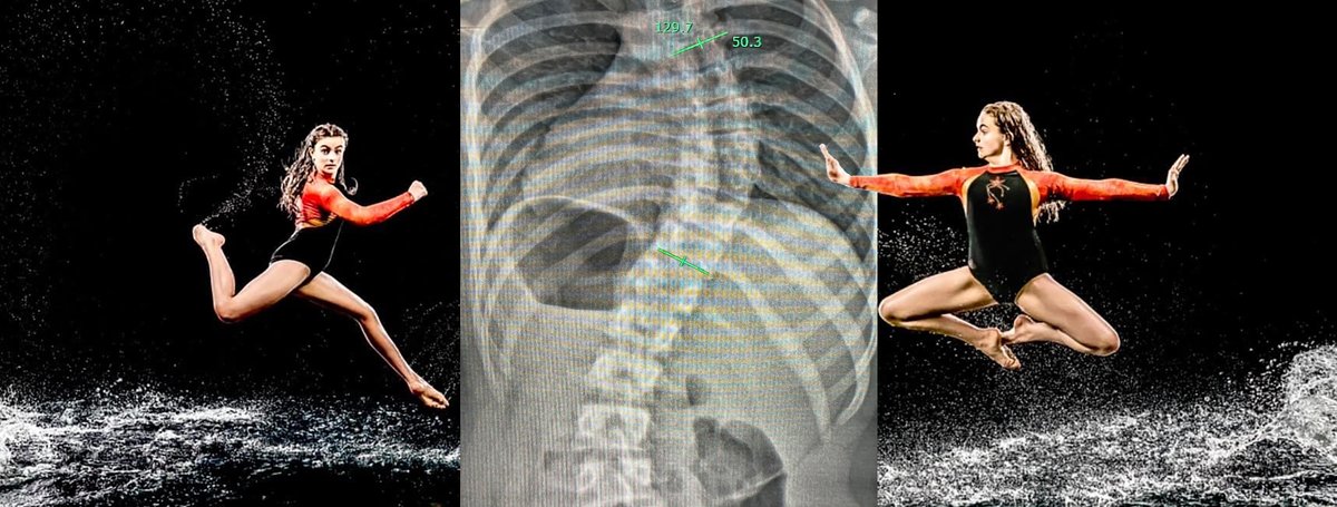 MiaVbt's tweet photo. @WhatsOnStage please would you be kind enough to RT https://t.co/hrrkSr0sVi to help keep my dream alive, it would mean the world to me, thank you X
#HaveYouGotMiasBack
#MiasVBTjourney
#BackSurgery
#VBT
#Dancer
#Dance
#LoveDance
#LeedsDancer
#YoungDancer
#BentNotBroken https://t.co/CFxj3IsHib