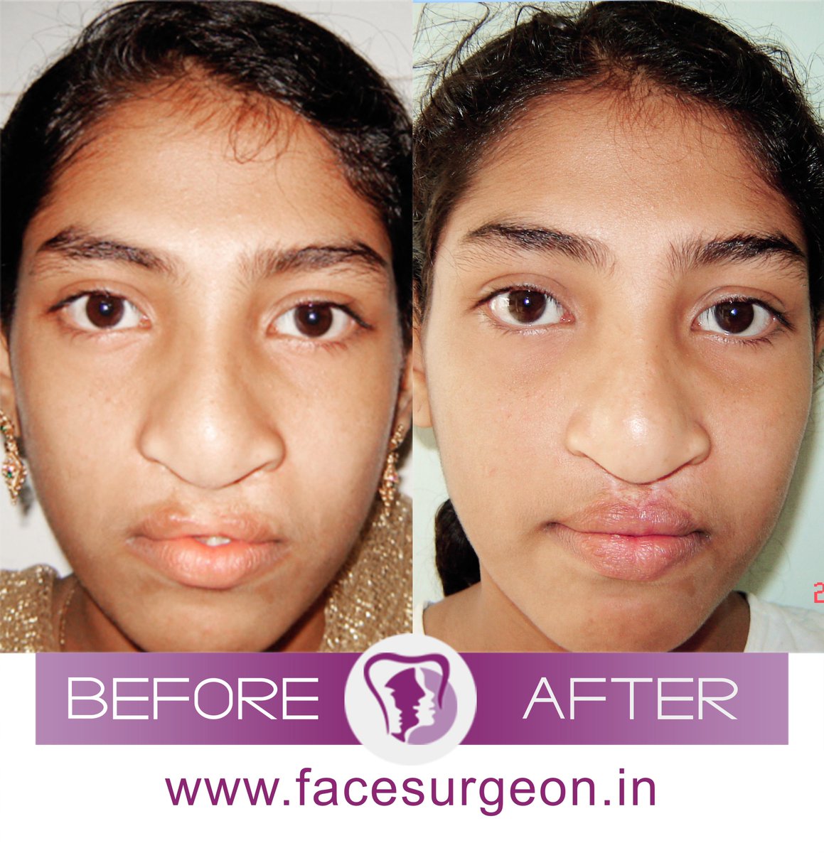 AndeiSoI's tweet photo. Amazing results achieved for Lip revision for a young girl in India #lipsugery #lips #facemakeover #drsunilrichardson #MedTwitter #MedEd #faces #smile #smiledesigning #facedoctor #lips https://t.co/RFOelGLZNT