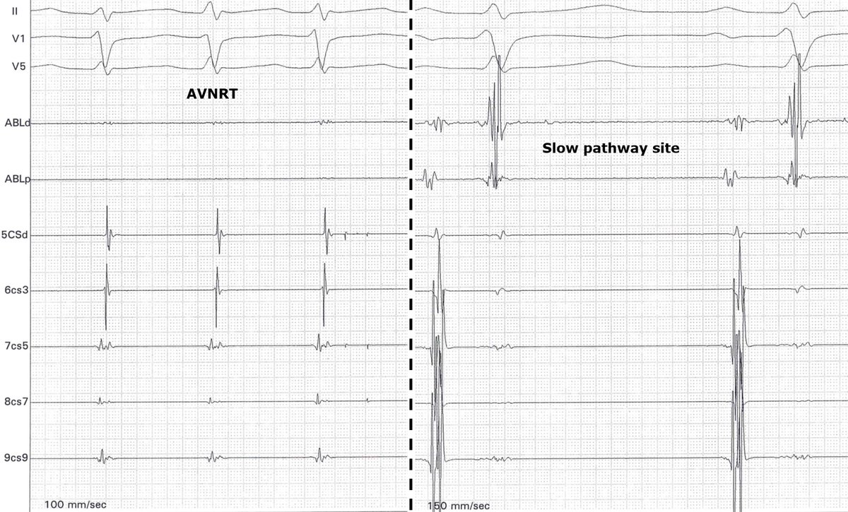 rfablation's tweet photo. 14 yoM with recurrent AVNRT. Mandatory #fluoroless RF #ablation. Nice potentials and slow pathway gone after one minute RF application with pretty good junctionals. With @messapus #EPeeps @DrRoderickTung @PaoloDellaBell1 #cardiotwitter @sozi81 @MilenaAste https://t.co/ilR2hvzidT