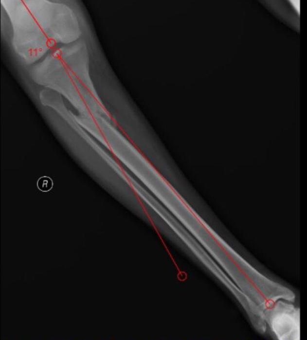 bone_mechanic's tweet photo. #orthotwitter 
#MedTwitter 
@kneedoclond @KneeUnit @DrBhavinJadav @DeepuSethi @OrthoFolks @ExeterKnee @kneeguyuk 
Case:
3 months old malunited proximal third tibia # f/b a MVA which was then treated conservatively by a quack outside.
Presented to us for definitive mx.
Rx Plan? https://t.co/7NUpIrL7bD